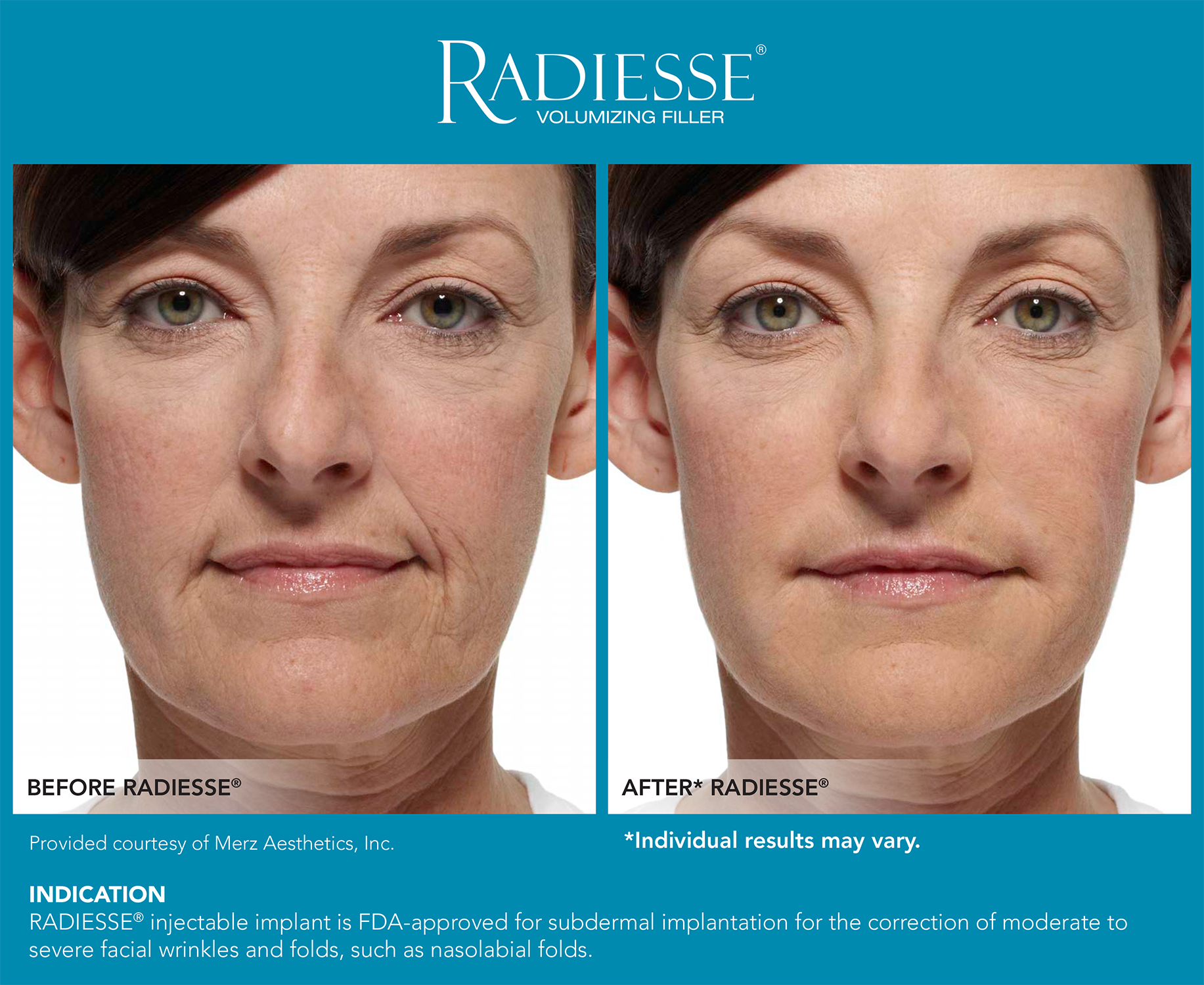 radiesse treatment in northern va