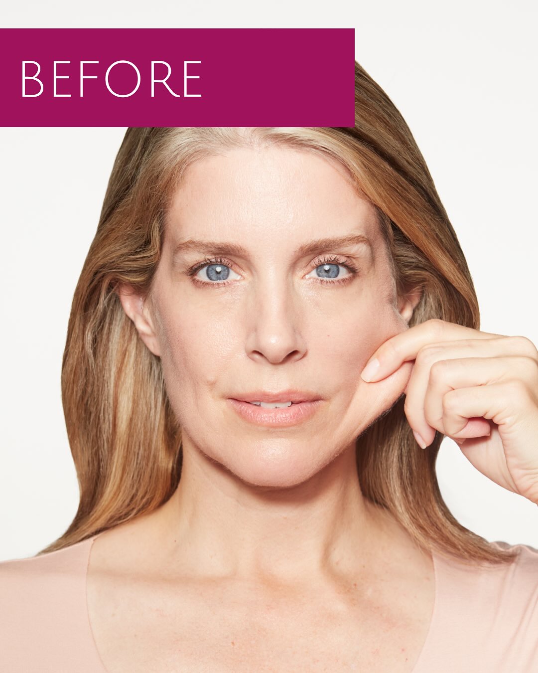 sculptra biostimulators