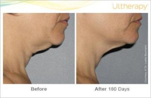 ultherapy-0026-0086w_beforeandafter_180day_1tx_neck2
