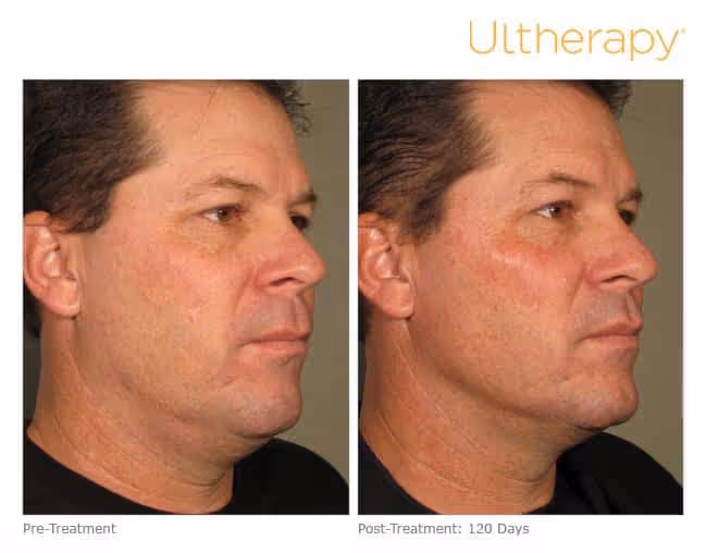 ultherapy: before-120daysafter_full-2