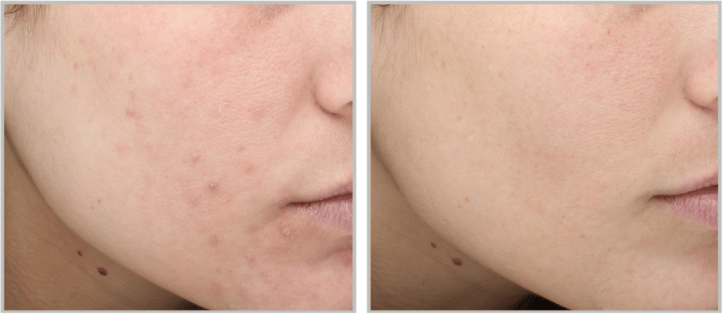 ND:YAG LASER