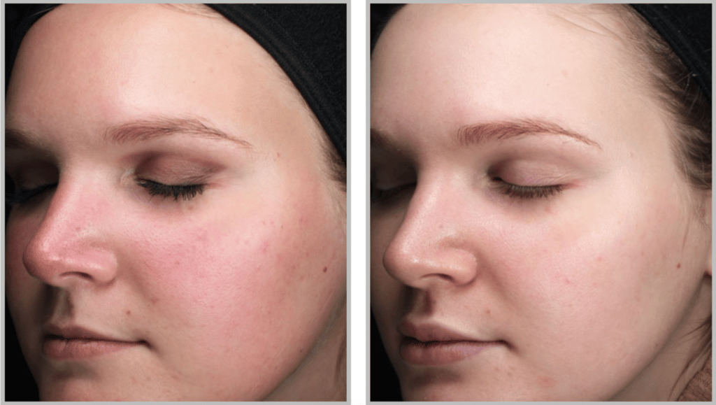 ND:YAG LASER