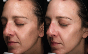 before and after moxi treatment