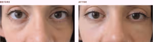 before and after eye fillers