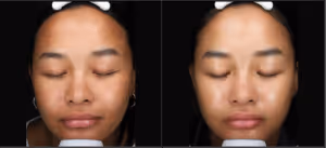 Moxi laser before and after pictures