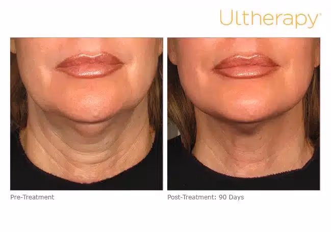 ultherapy: before-90daysafter_lower|ultherapy-0058d_before-120daysafter_full-2|ultherapy_007kmp_beforeandafter-180day_1tx_chest|ultherapy-0026-0086w_beforeandafter_180day_1tx_neck2|ultherapy-024g-002u_before-120daysafter_brow-2|ultherapy-0026-0086w_beforeandafter_180day_1tx_neck2|ultherapy: before-120daysafter_full-2|ultherapy-p011_before-180days_full|ultherapy_003dky_beforeandafter-180day_1tx_chest|ultherapy: beforeandafter-180day_1tx_chest|ultherapy-0007-0093ah-beforeandafter-180day_1tx_chest