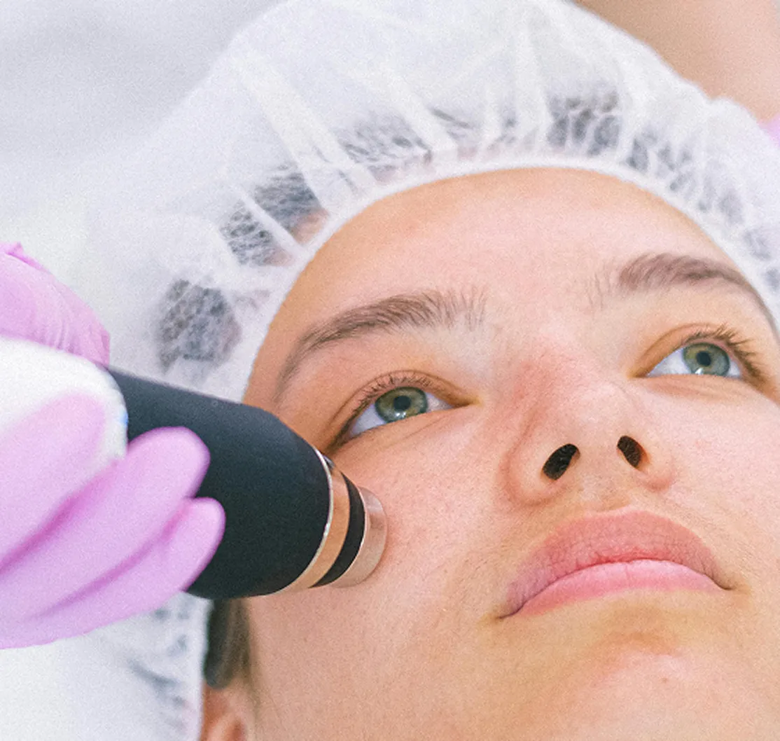woman getting fractional skin resurfacing done on face
