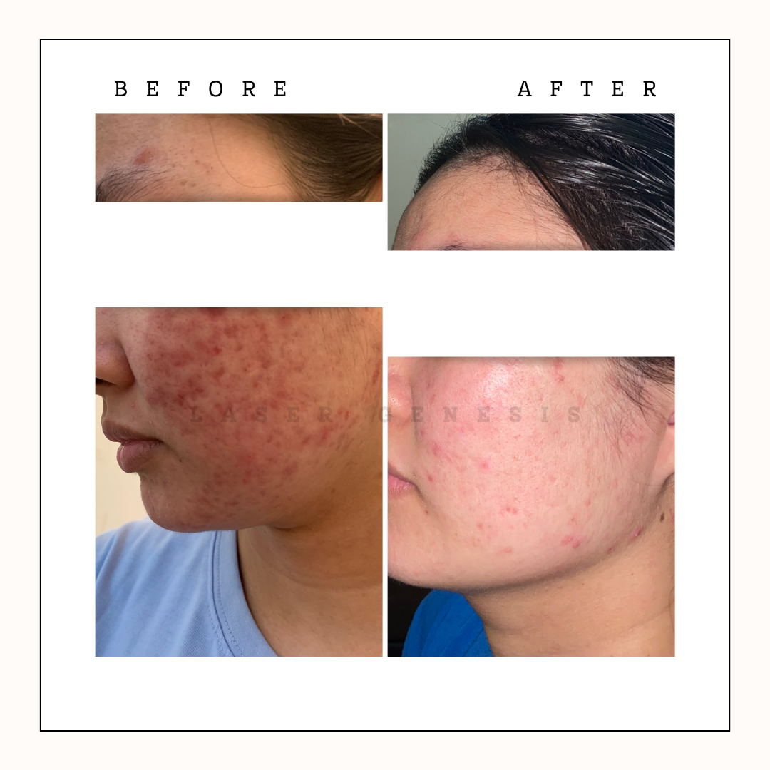 Acne Care & Treatment: A Complete Guide for All Skin Types