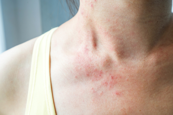 Woman with ezcema on neck area. 