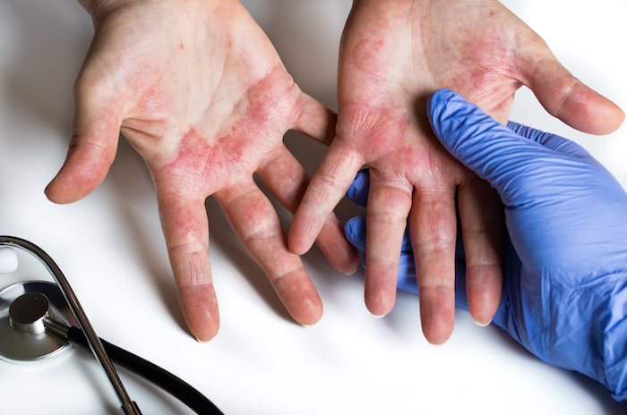 Doctor examining ezcema on patient's hands. 