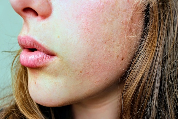 Woman with rosacea on face. 