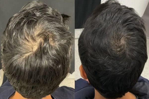 Before and after hair loss treatment. 
