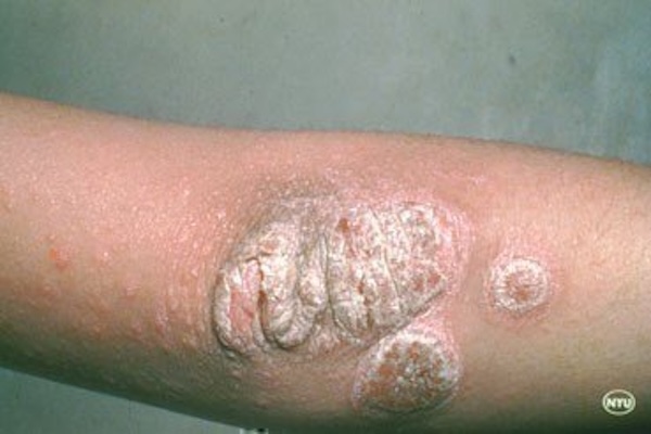 Psoriasis on elbow, close up. 
