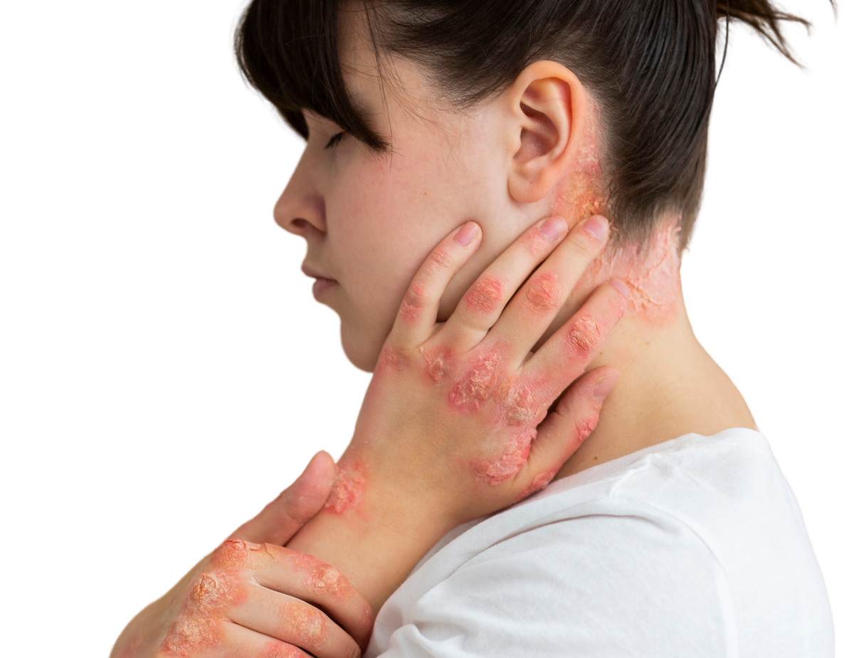 Lady with psoriasis on hands and neck. 