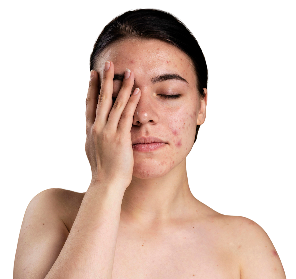 Woman with acne on face. 