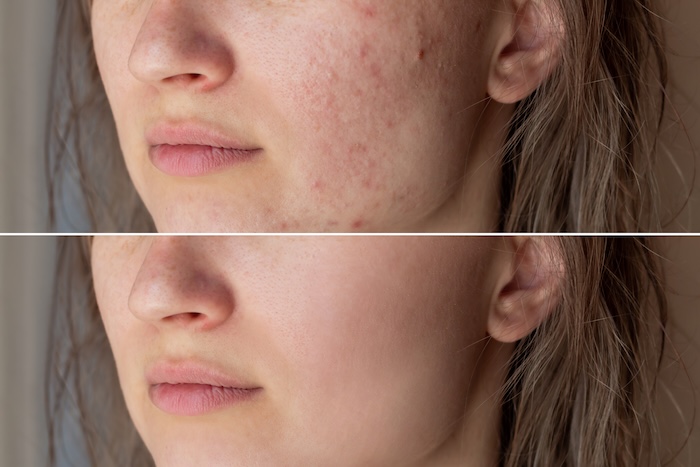 Before and after acne treatment. 