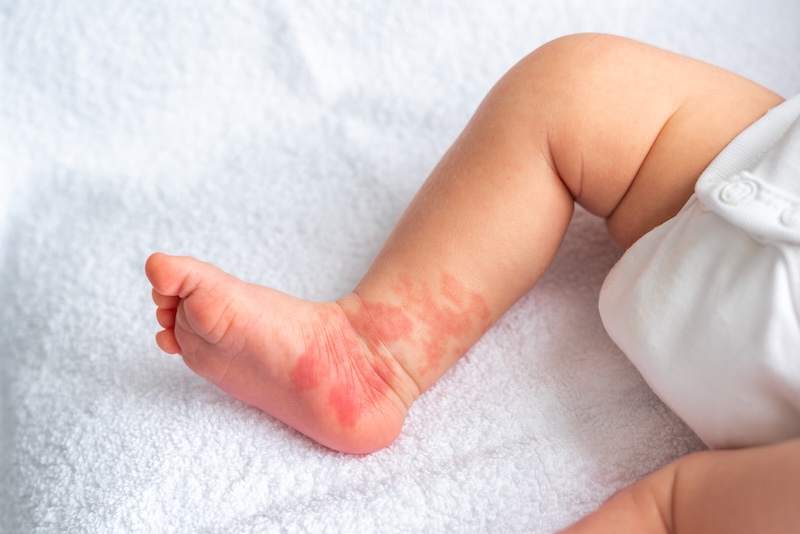 Rash on baby, on lower leg. 