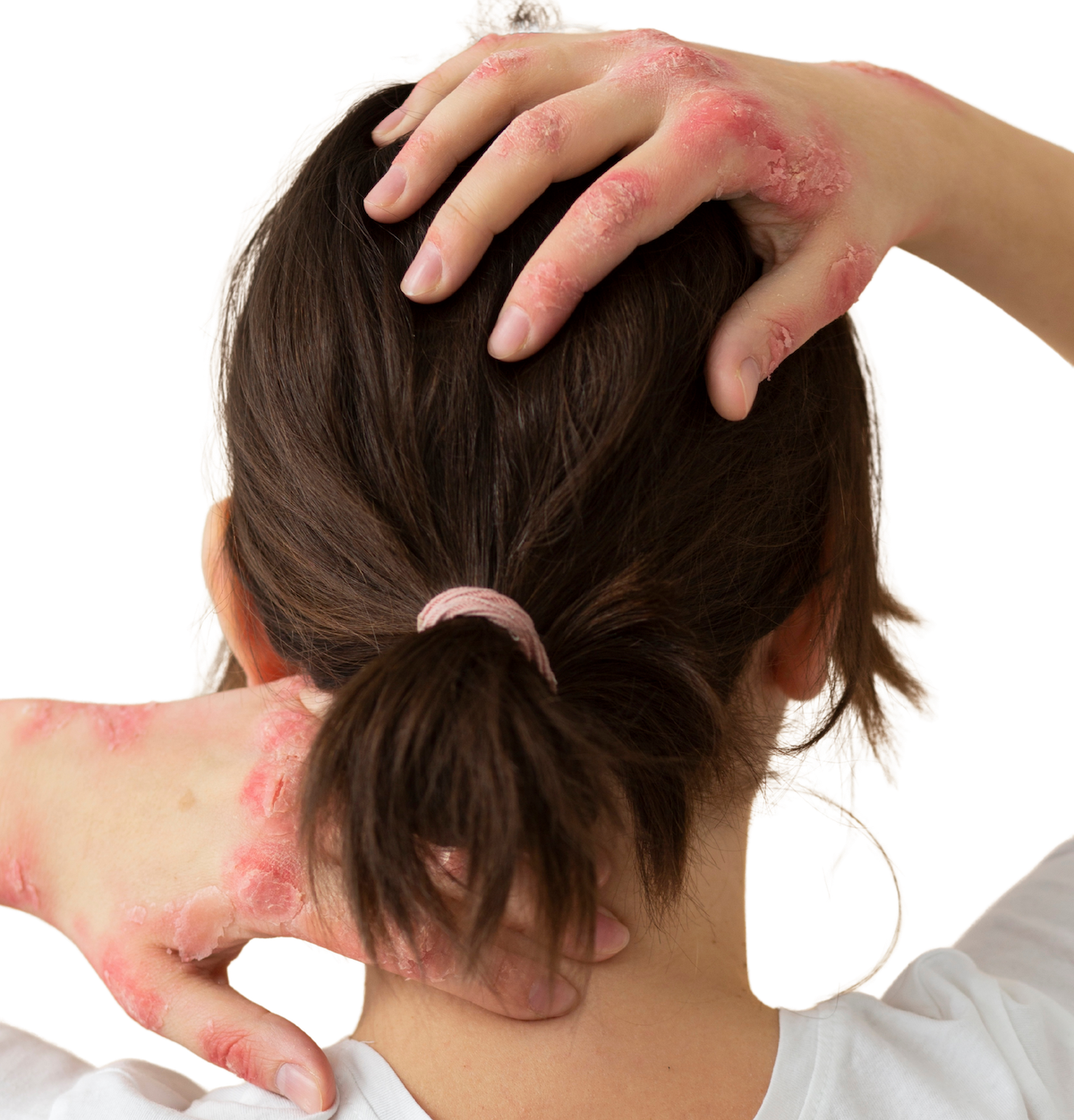 Eczema patient with eczema on hands. 