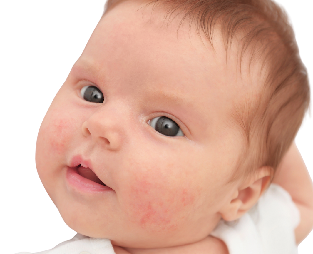 Baby with eczema on face. 