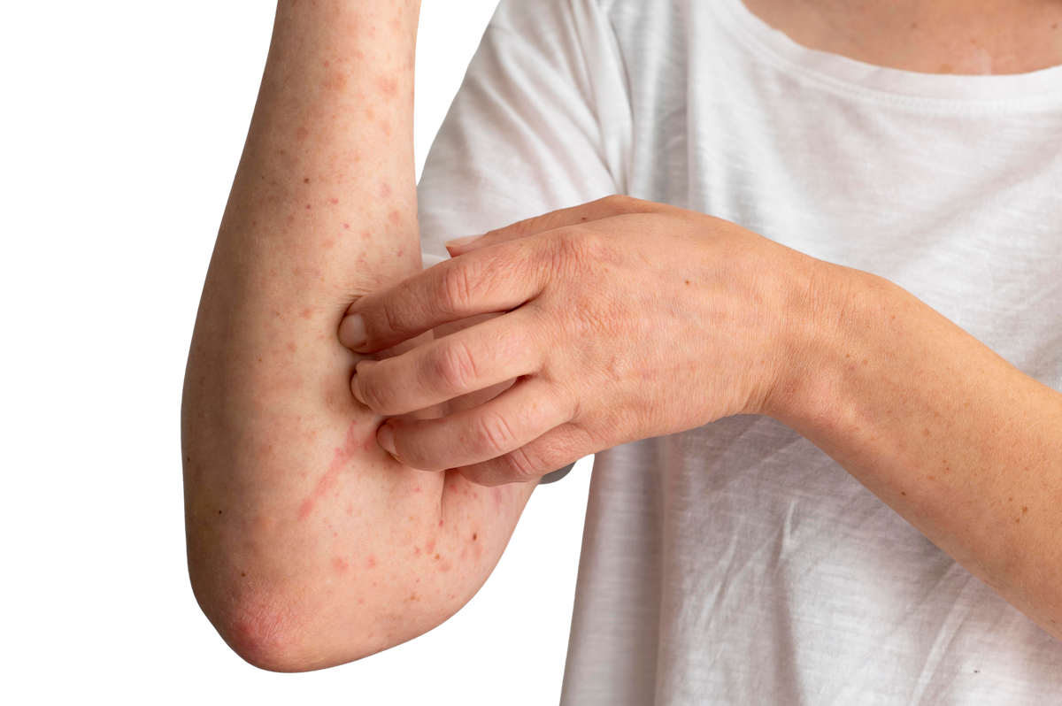 Hives on woman's arm. 