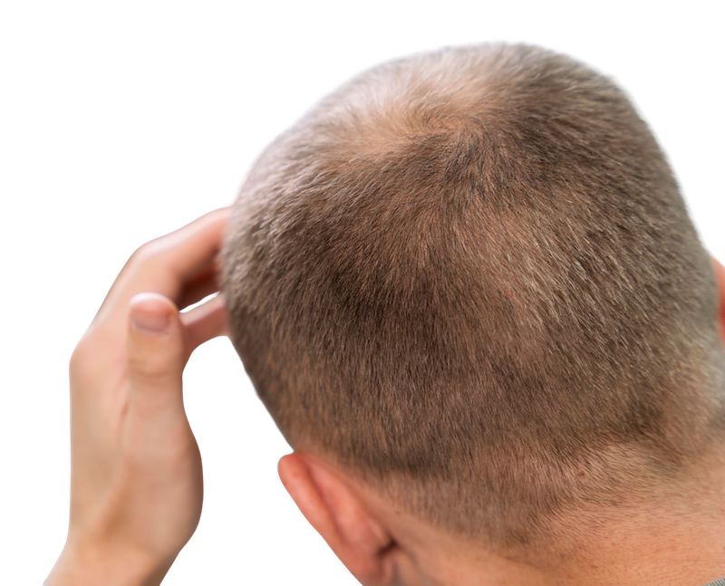 Man touching hair, thinning hair. 