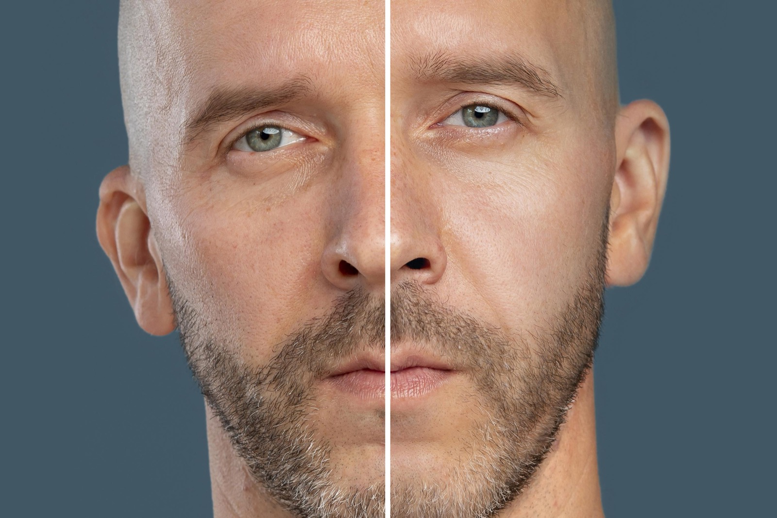 Microneedling-Ergebnisse