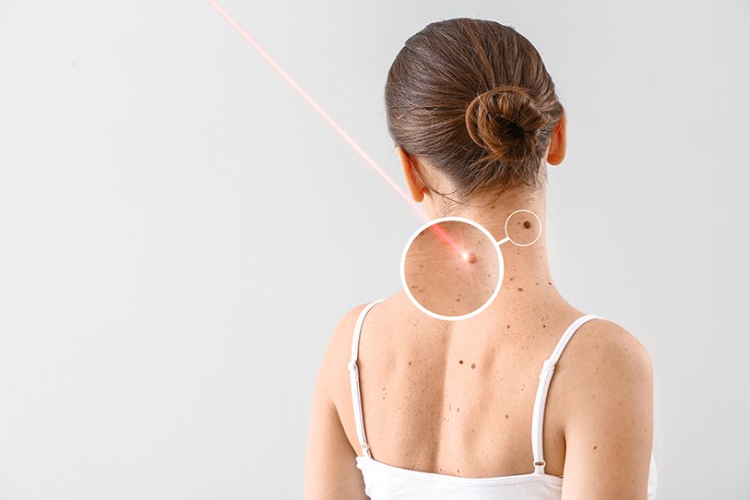 Qu’est-ce-que le laser Clarity ?