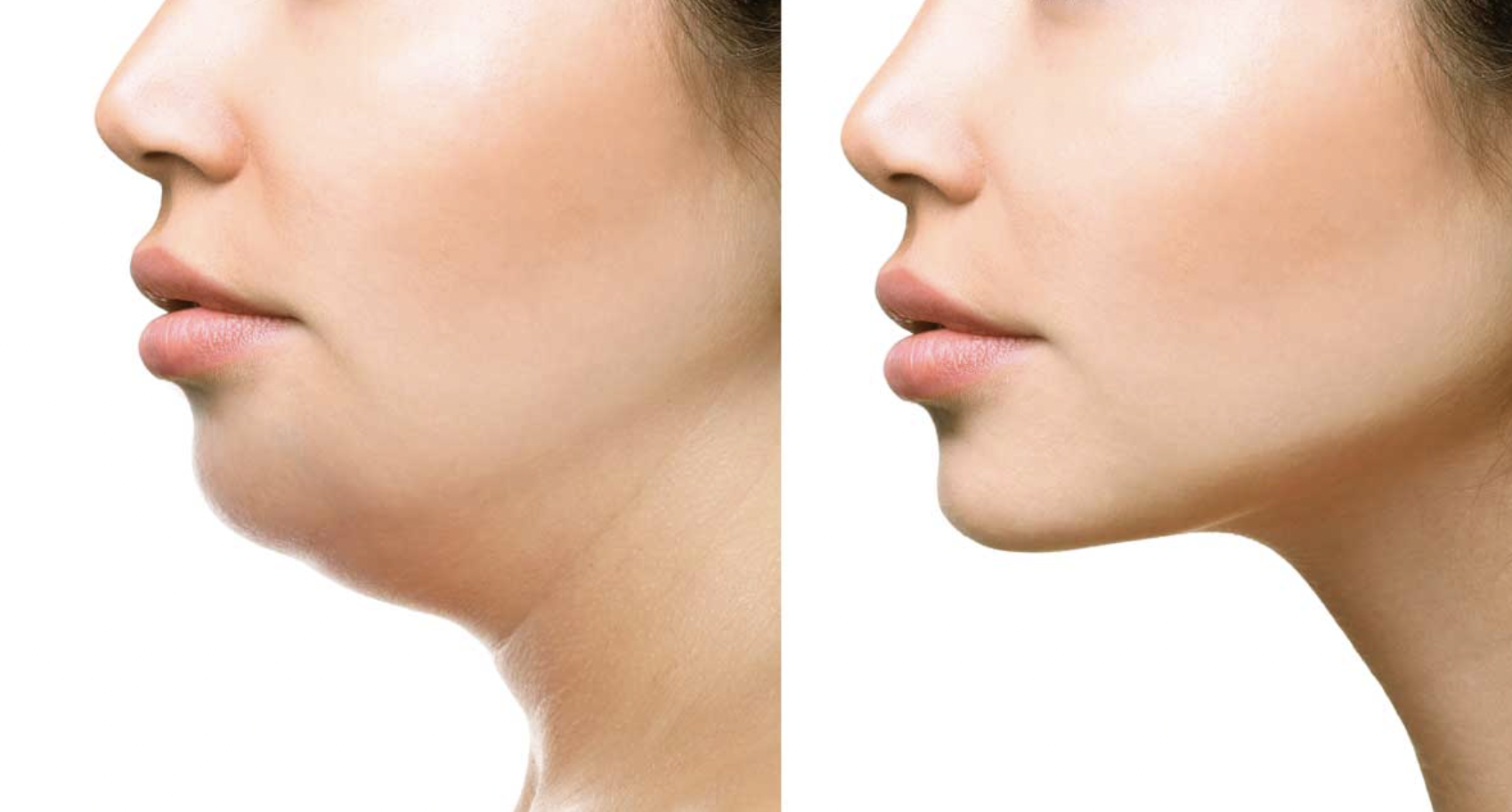 Résultats de l'injection de lipolyse