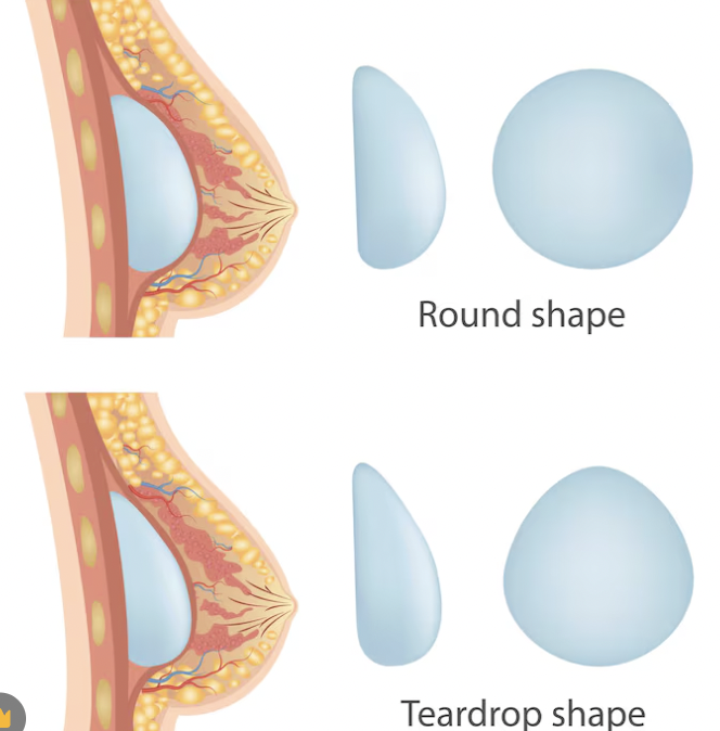 Augmentation mammaire