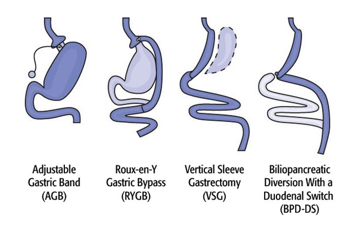Bariatric Surgery & Weight-Loss Surgery Options | Live Science
