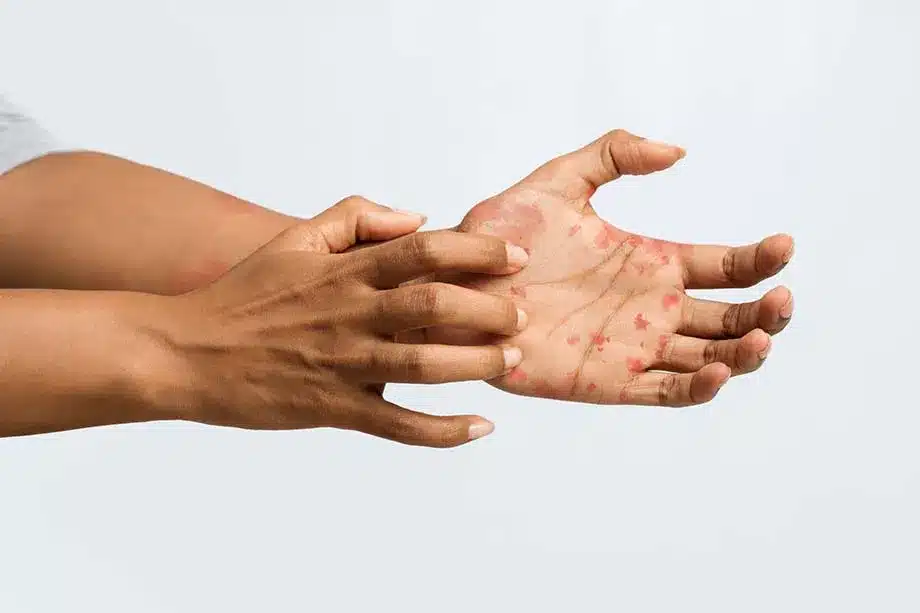 formation reperage diagnostic dermatologie peau foncee (Démarche diagnostique en dermatologie)