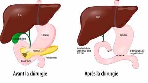 DPC operation : deroulement pratique duodenopancreatectomie cephalique avant apres