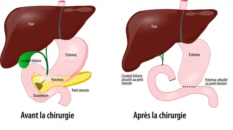 DPC operation : deroulement pratique duodenopancreatectomie cephalique avant apres