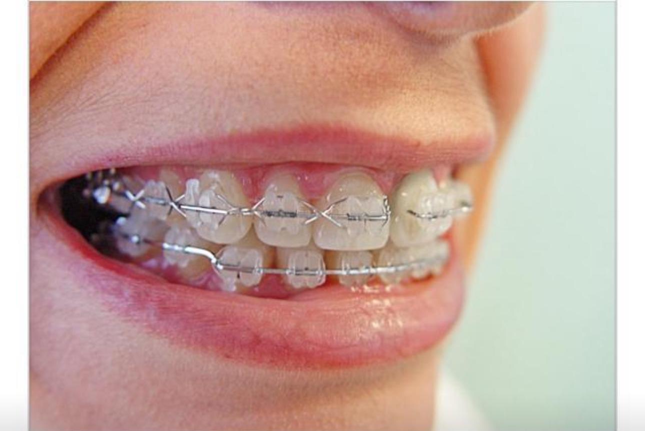 Teeth Straightening