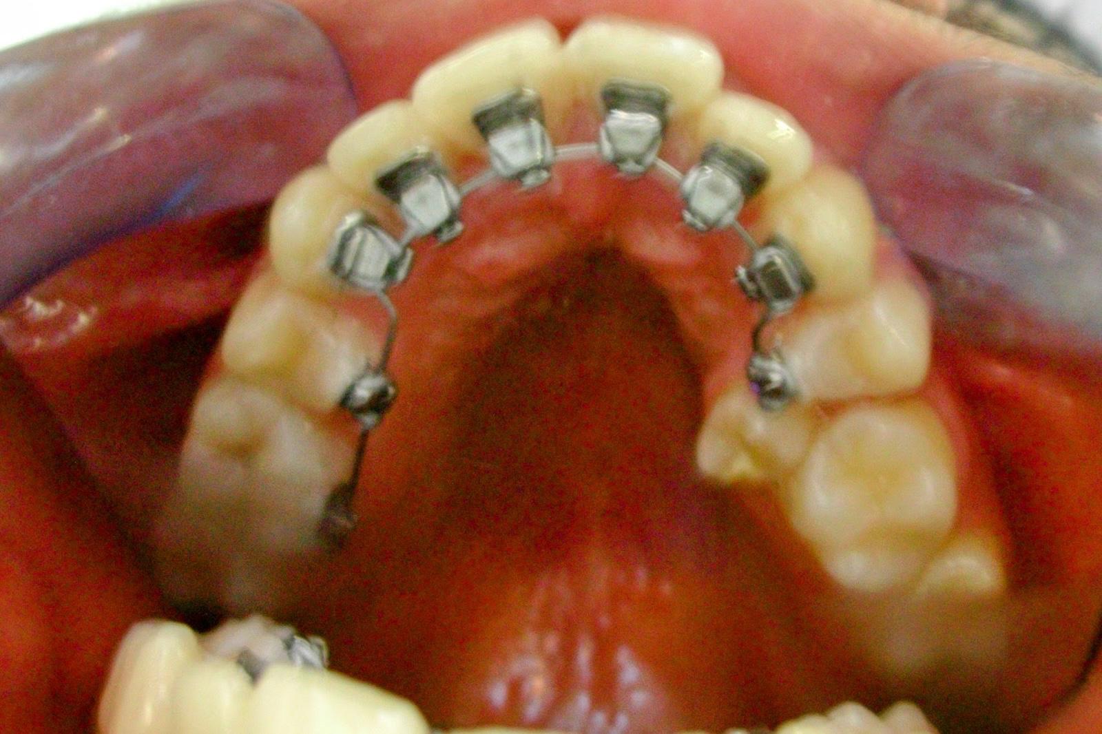 Lingual braces