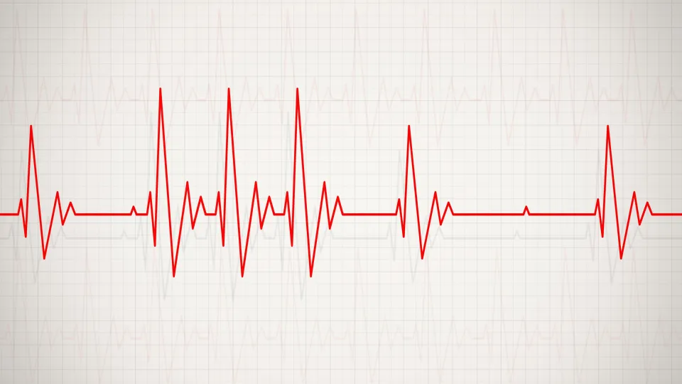 Patient med långtids-EKG-registrering som utreder oregelbunden hjärtrytm på GlobenHeart i Stockholm