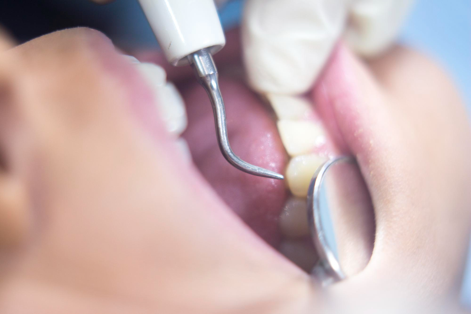 Professzionális fogkőeltávolítás