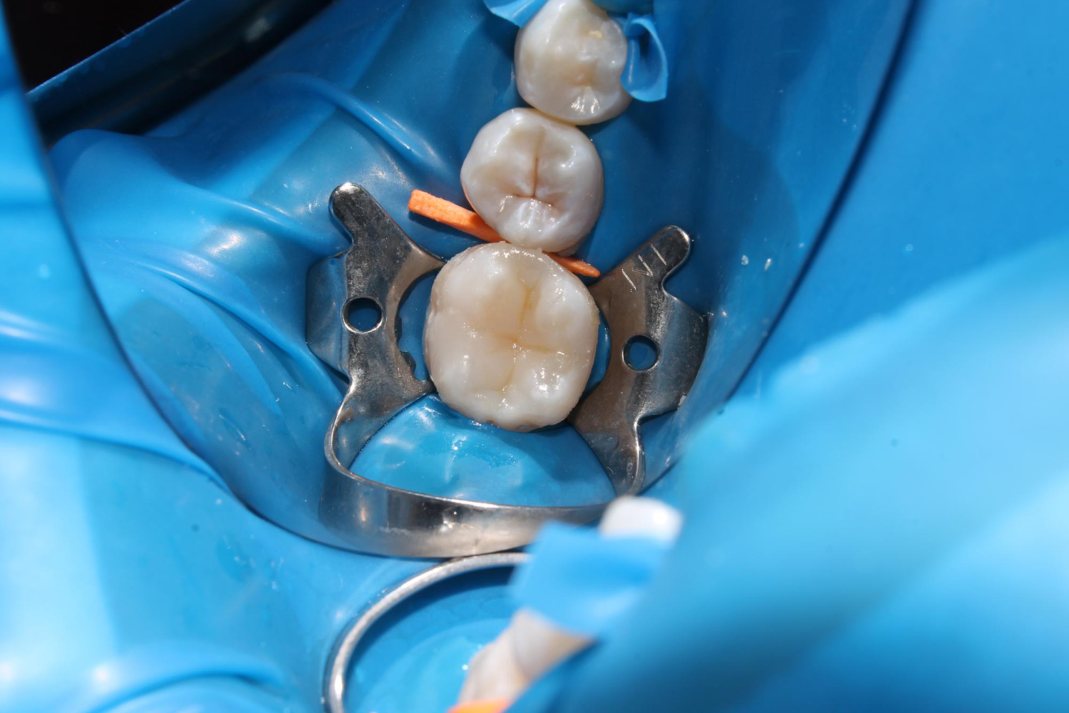 Esztétikus tömések