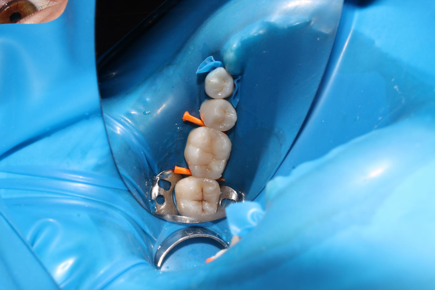 Biomimetikus fogfelépítés