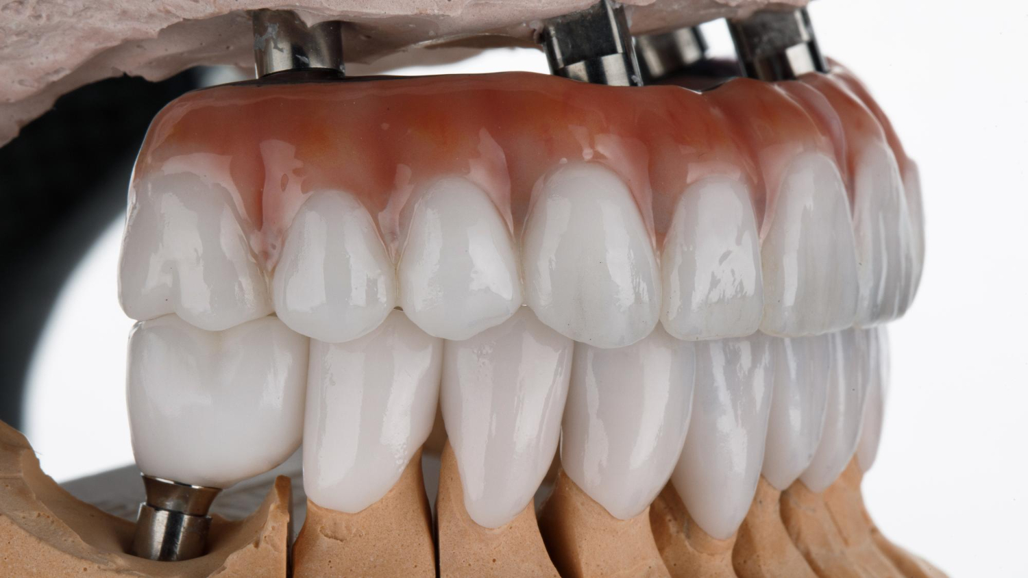 All-on-4 és All-on-6 implantátumon rögzített fogpótlás