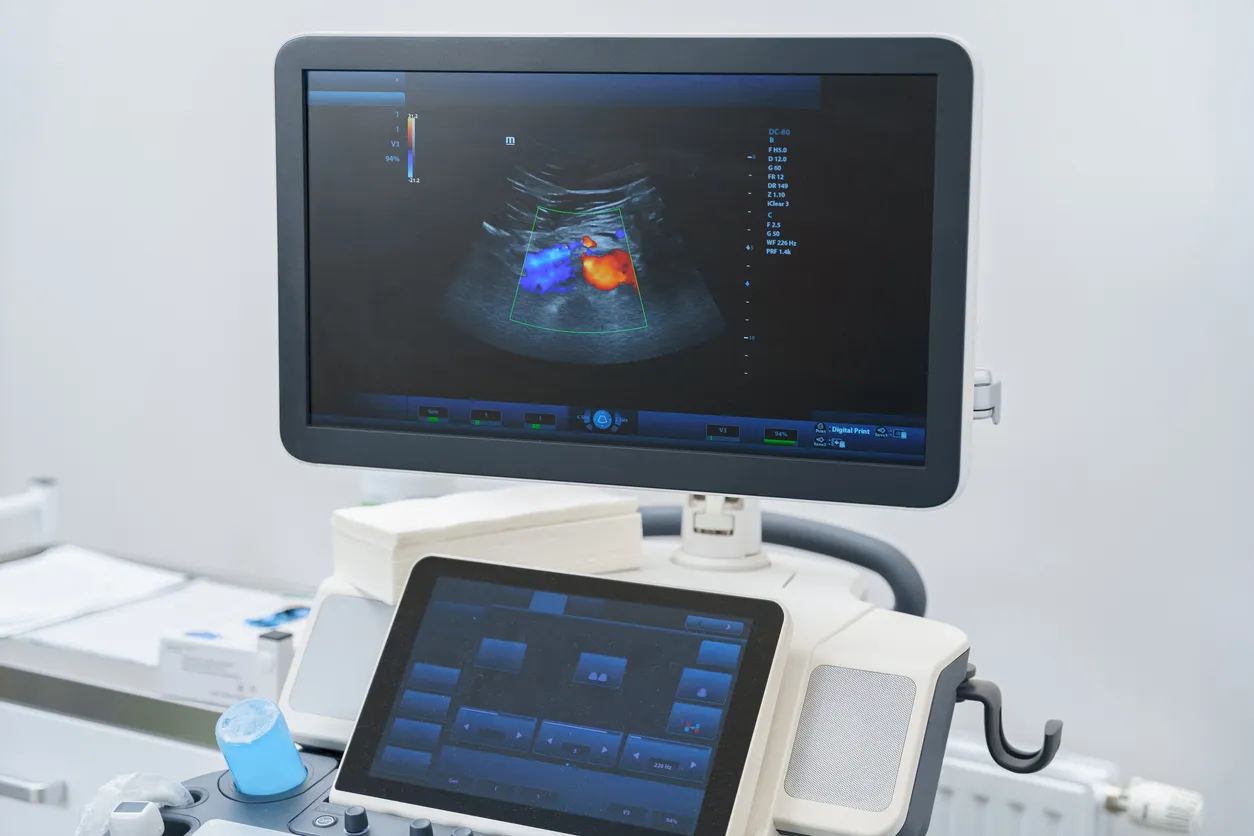 An echocardiography machine displaying a colour Doppler study of the heart