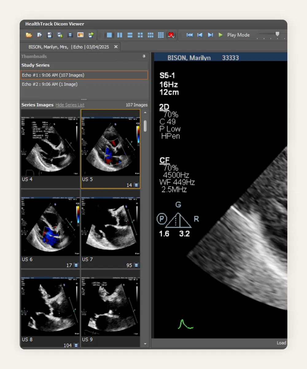 HealthTrack DICOM viewer showing an echocardiogram study, with 107 images as thumbnails and a colour Doppler image enlarged