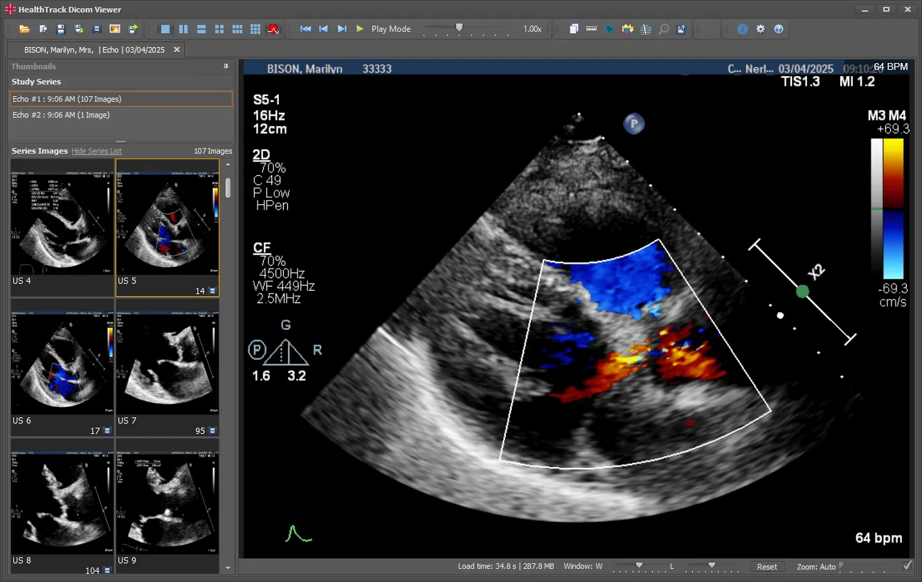 HealthTrack echocardiogram viewer showing a colour Doppler study with prior loops as thumbnails and measurement panels alongside
