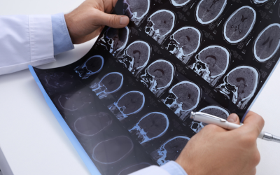 epilepsy brain scan