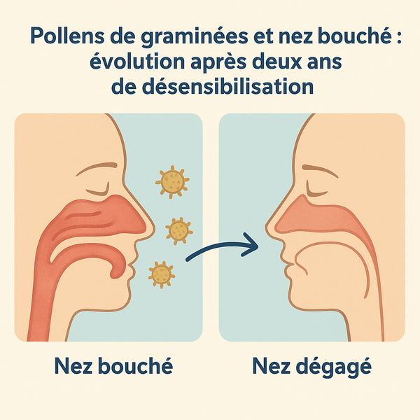 Pollens de graminées et nez bouché : évolution après deux ans de désensibilisation
