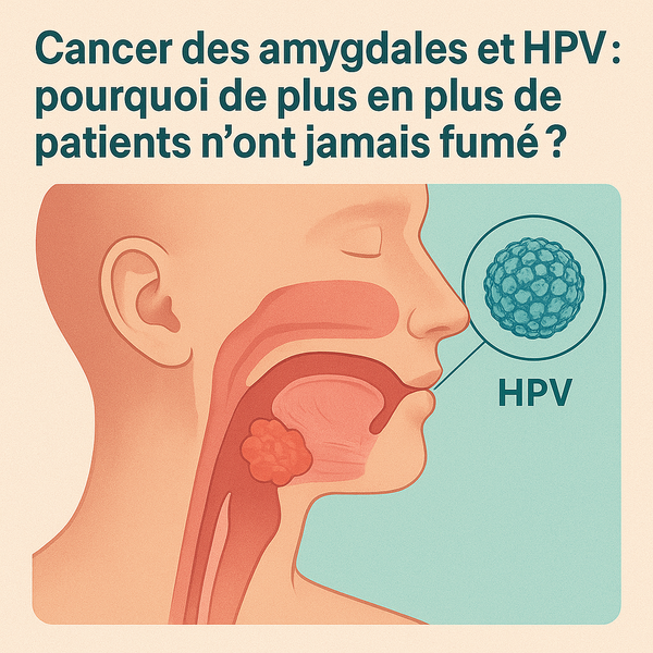 Cancer des amygdales et HPV : pourquoi de plus en plus de patients n'ont jamais fumé ?