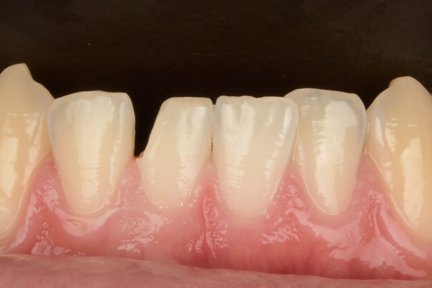 3D Printed Fractional Veneer detail 1