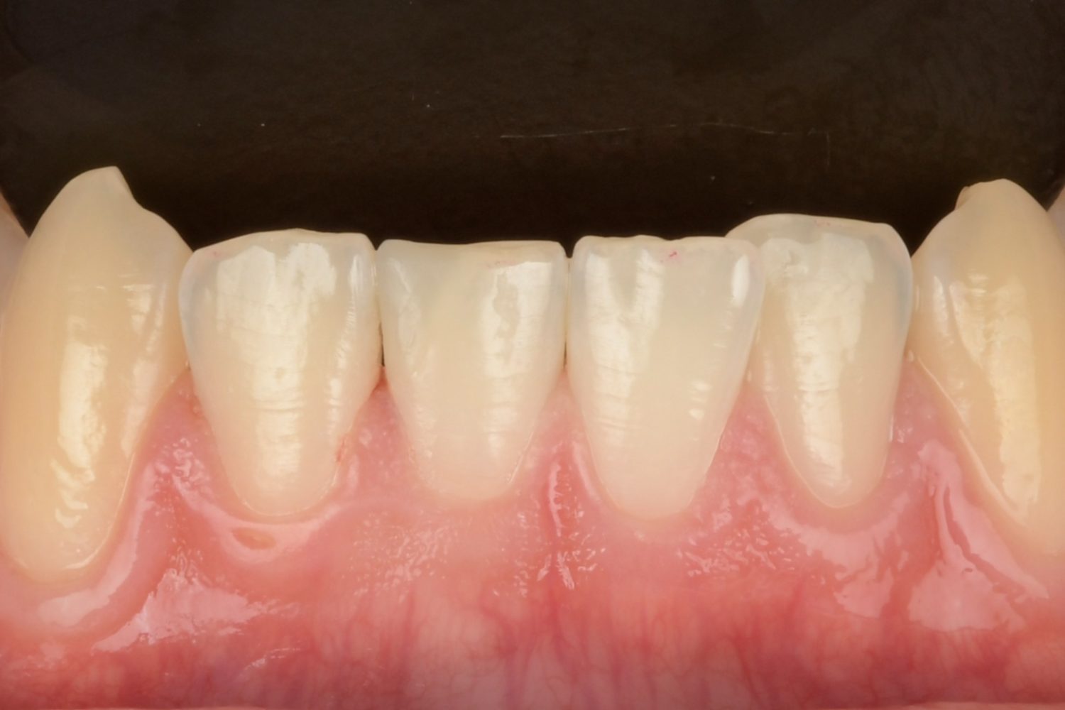 3D Printed Fractional Veneer detail 3