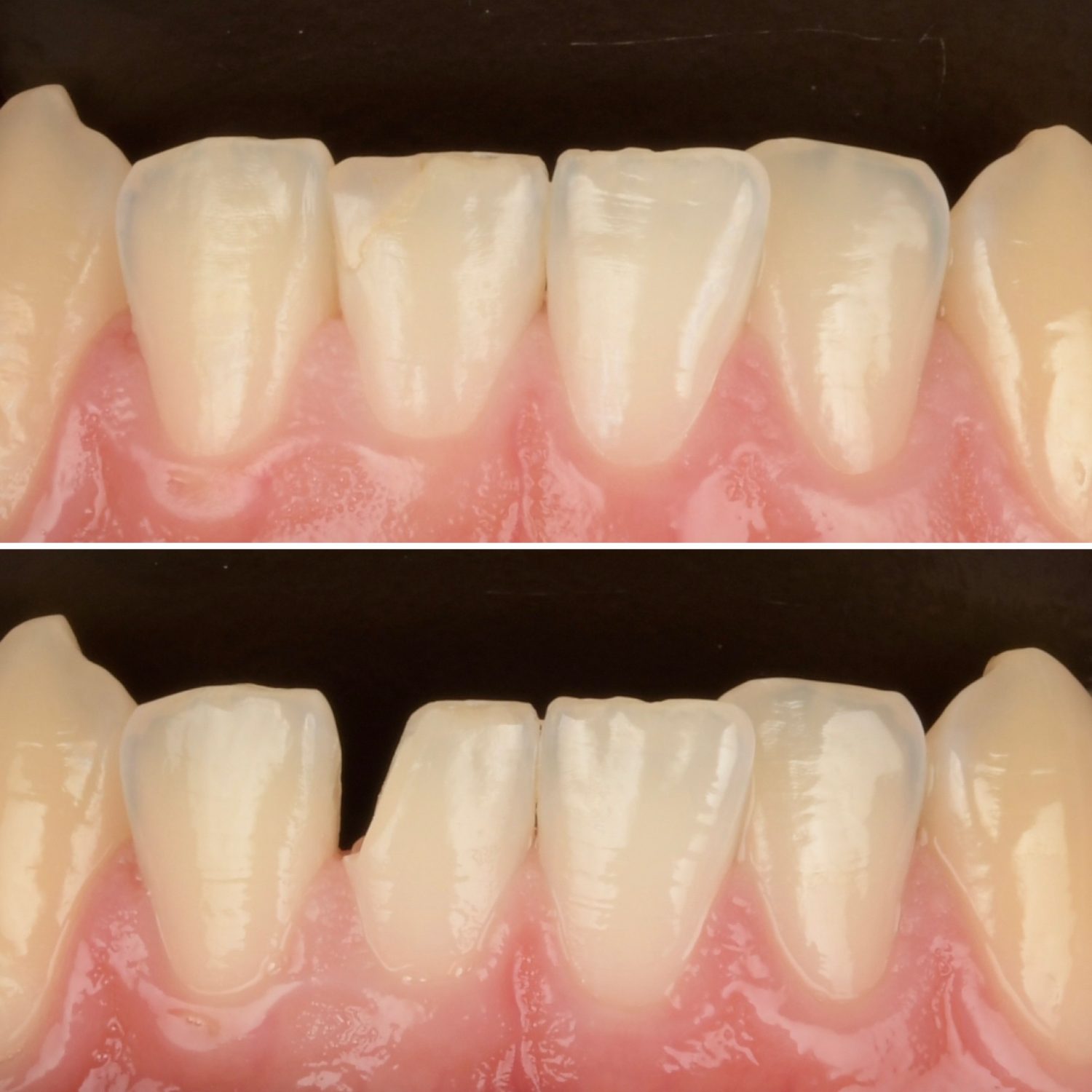 3D printed fractional veneer before and after