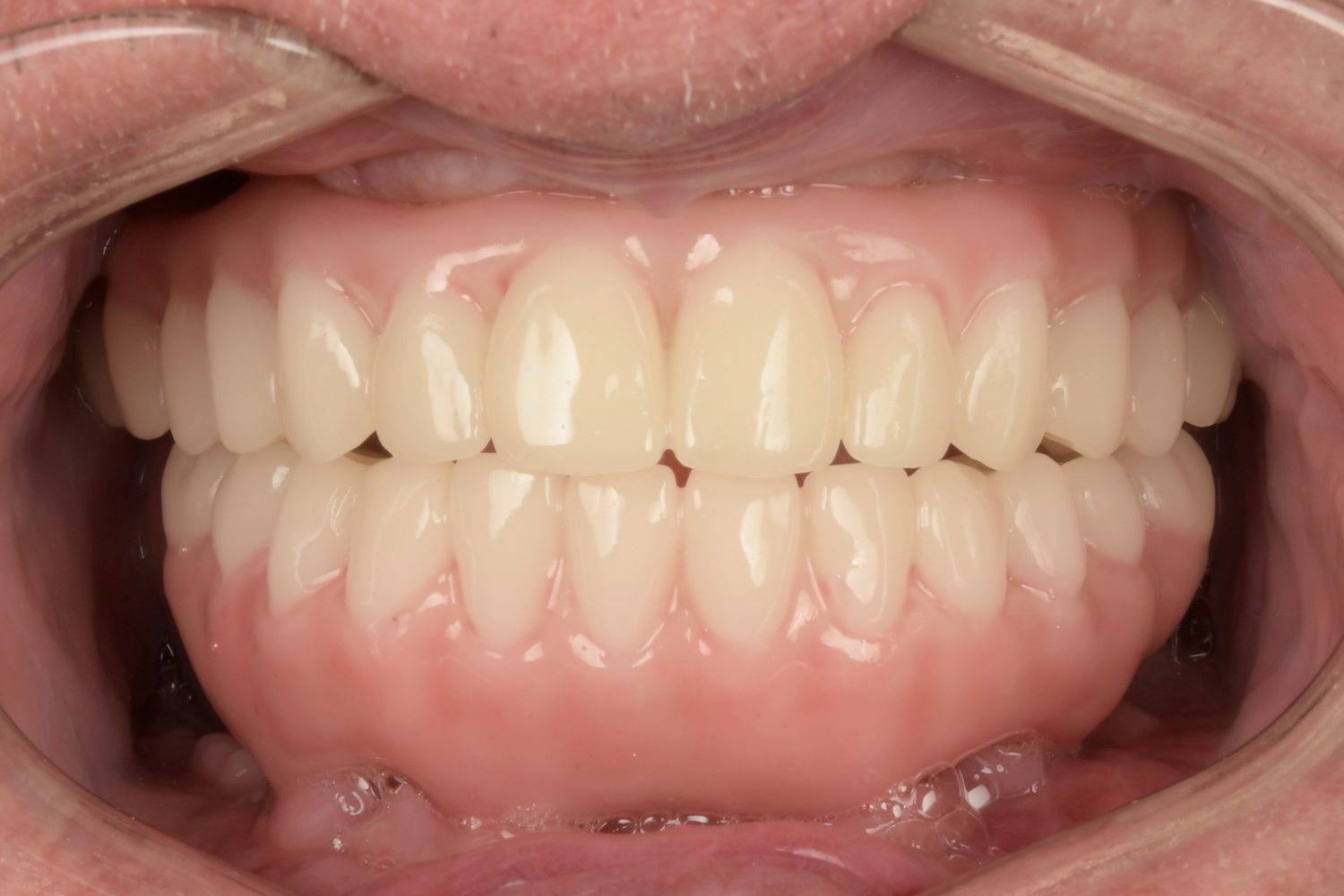 All-on-X full arch final result in mouth